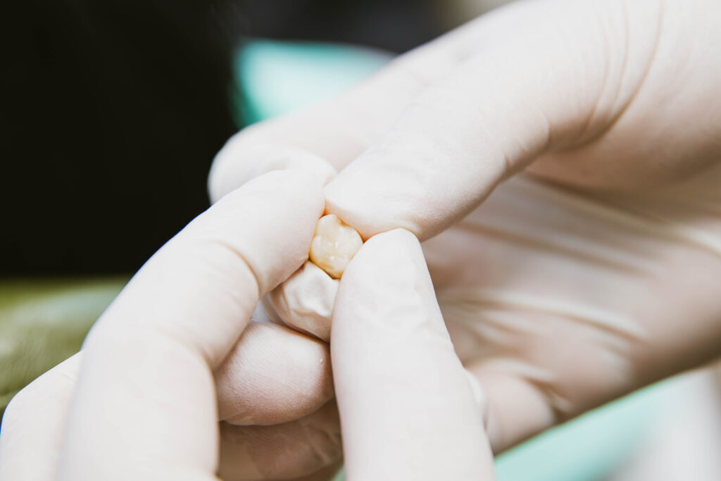 Corona dentale fissa in ceramica di alta qualità. Soluzioni di protesi dentali estetiche tra i nostri trattamenti studio dentistico.
