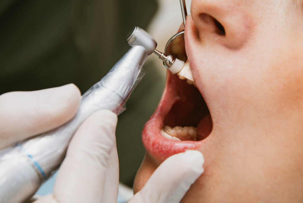 Trattamenti studio dentistico: seduta di igiene dentale professionale presso lo studio dentistico Catanzaro.