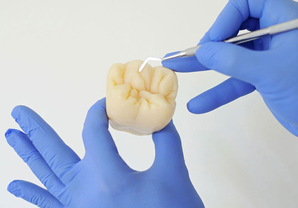Ricostruzione e otturazione estetica di un dente con composito. Odontoiatria conservativa tra i trattamenti studio dentistico.